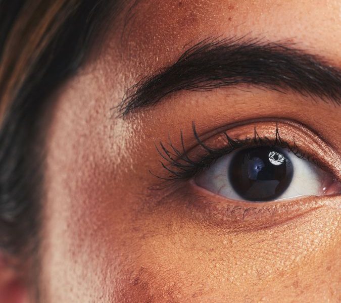 Pigmentfolt vagy melasma Nem minden barna folt egyforma (1)