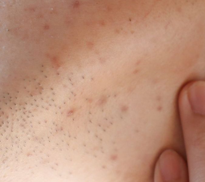 Pigmentfolt vagy melasma Nem minden barna folt egyforma (2)