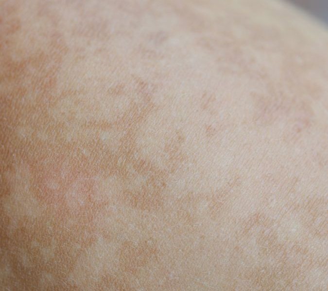 Pigmentfolt vagy melasma Nem minden barna folt egyforma (3)