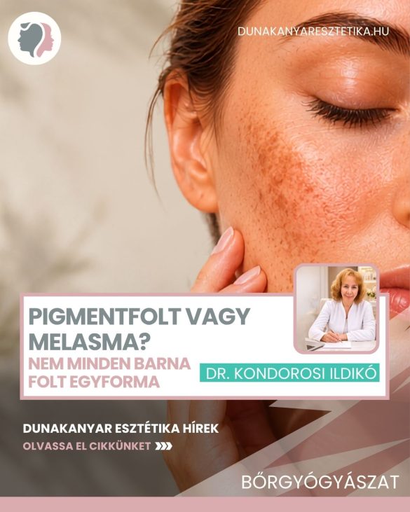 Pigmentfolt vagy melasma Nem minden barna folt egyforma – Dr. Kondorosi Ildikó
