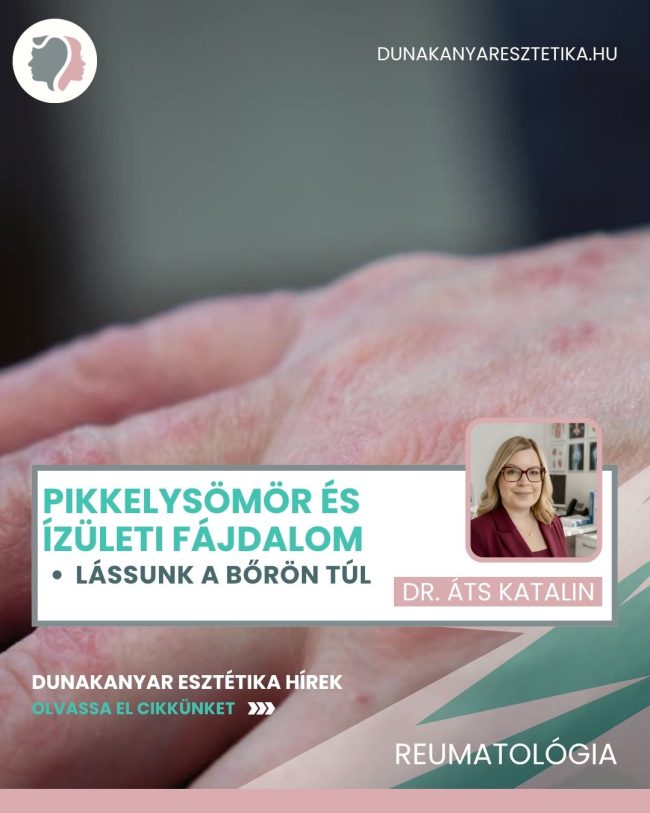 Pikkelysömör és ízületi fájdalom: lássunk a bőrön túl – Dr. Áts Katalin
